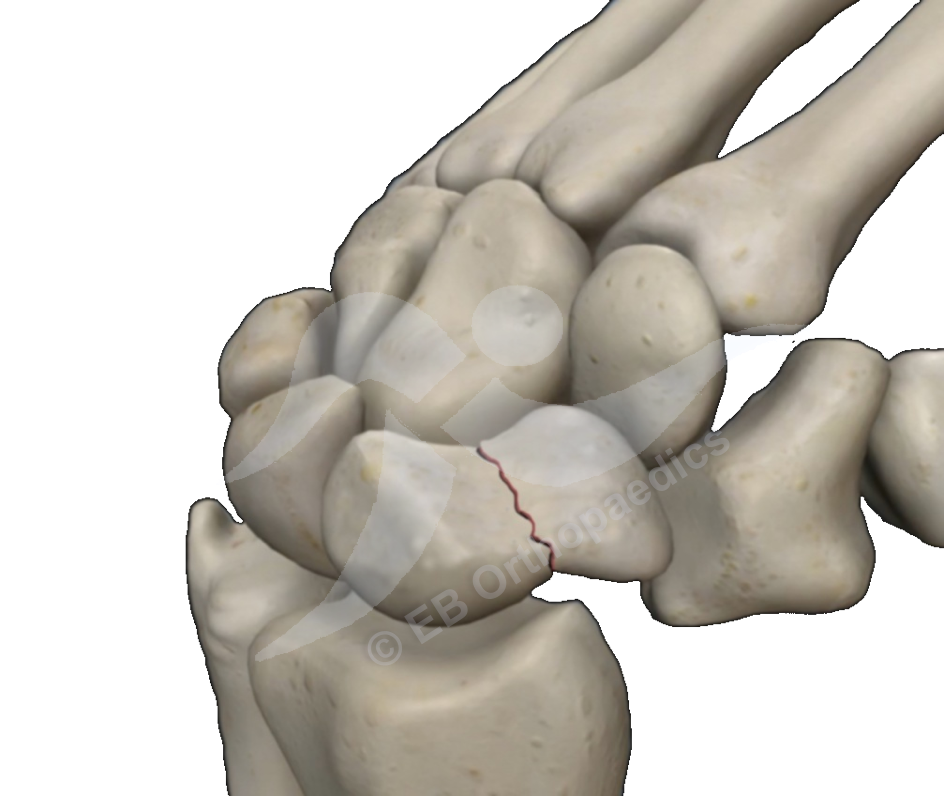 Scaphoid fractures